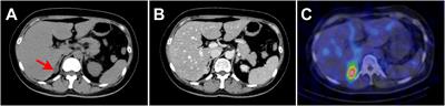 Double somatic mutations in CTNNB1 and GNA11 in an aldosterone-producing adenoma